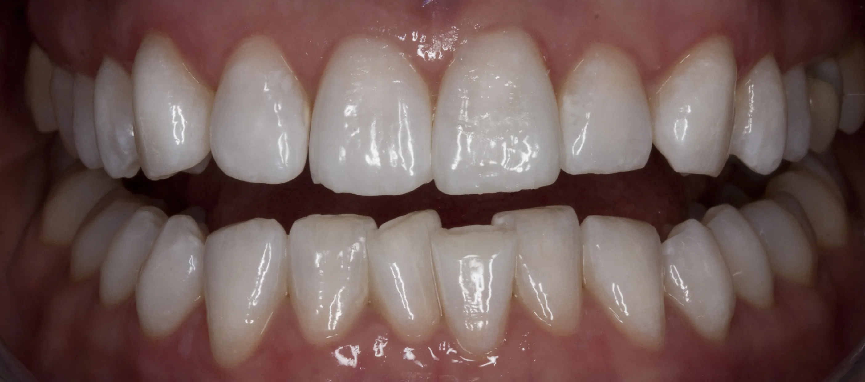 Nach der Behandlung — Professionelles Bleaching