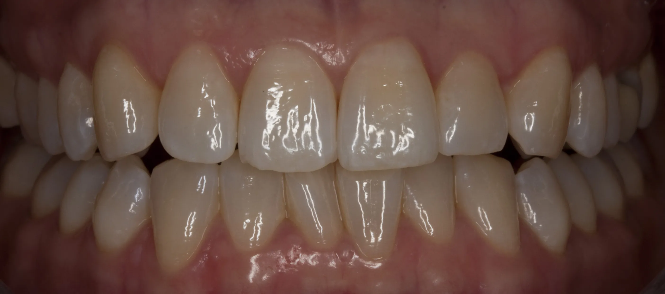 Vor der Behandlung — Professionelles Bleaching