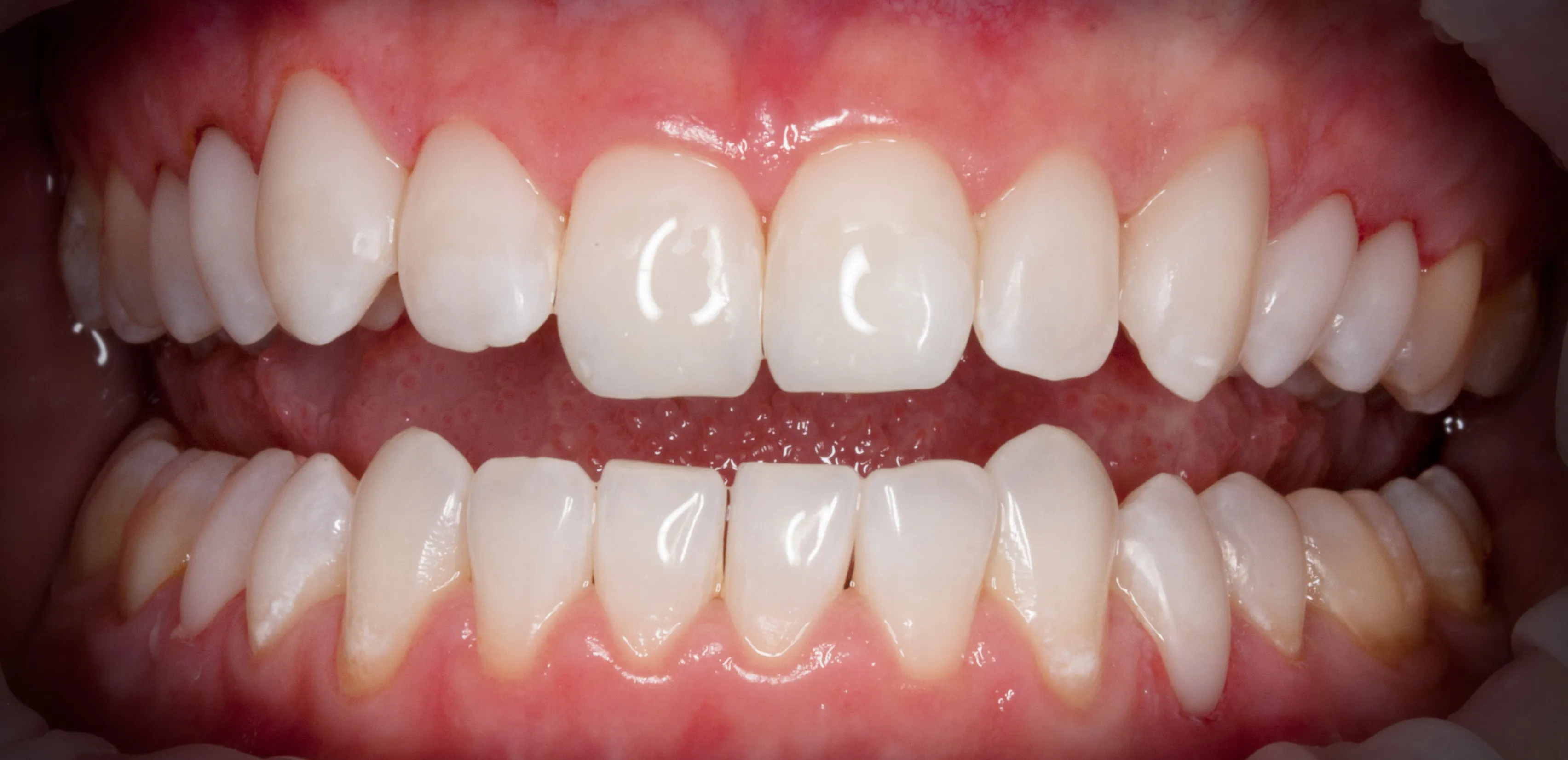 Nach der Behandlung — Rekonstruktion und Bleaching