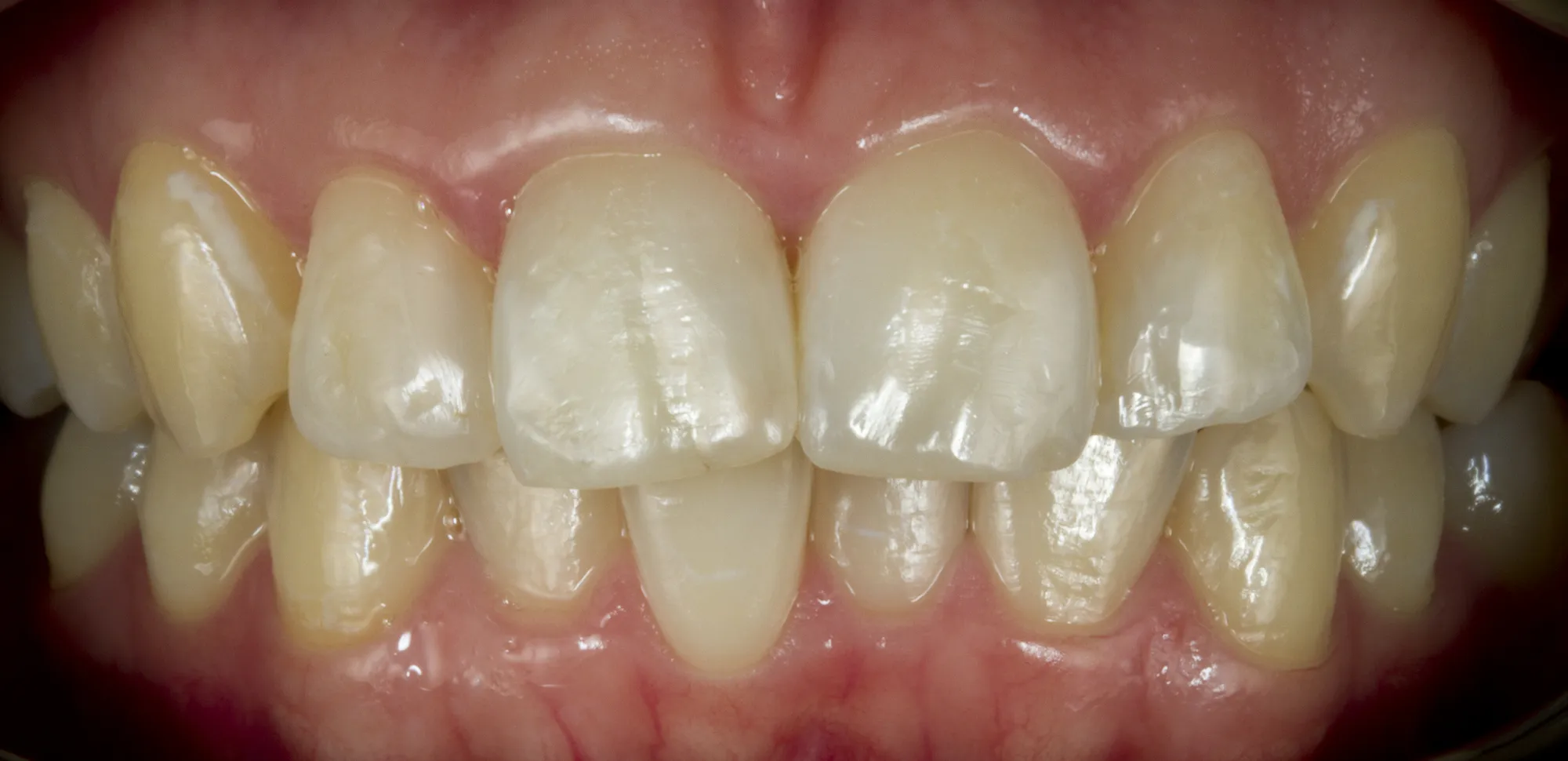Nach der Behandlung — Internes Bleaching eines toten Zahns