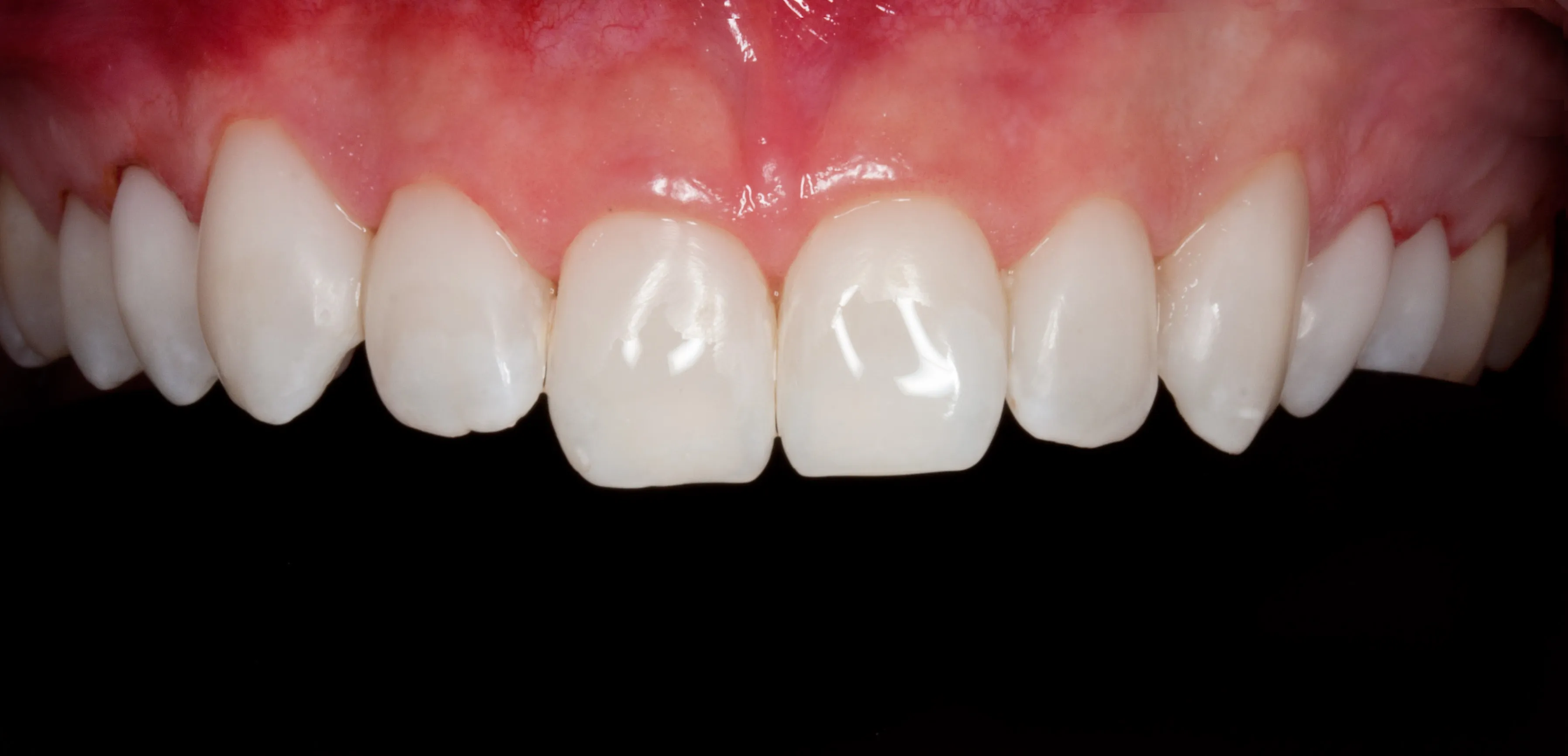 Nach der Behandlung — Rekonstruktion und Bleaching