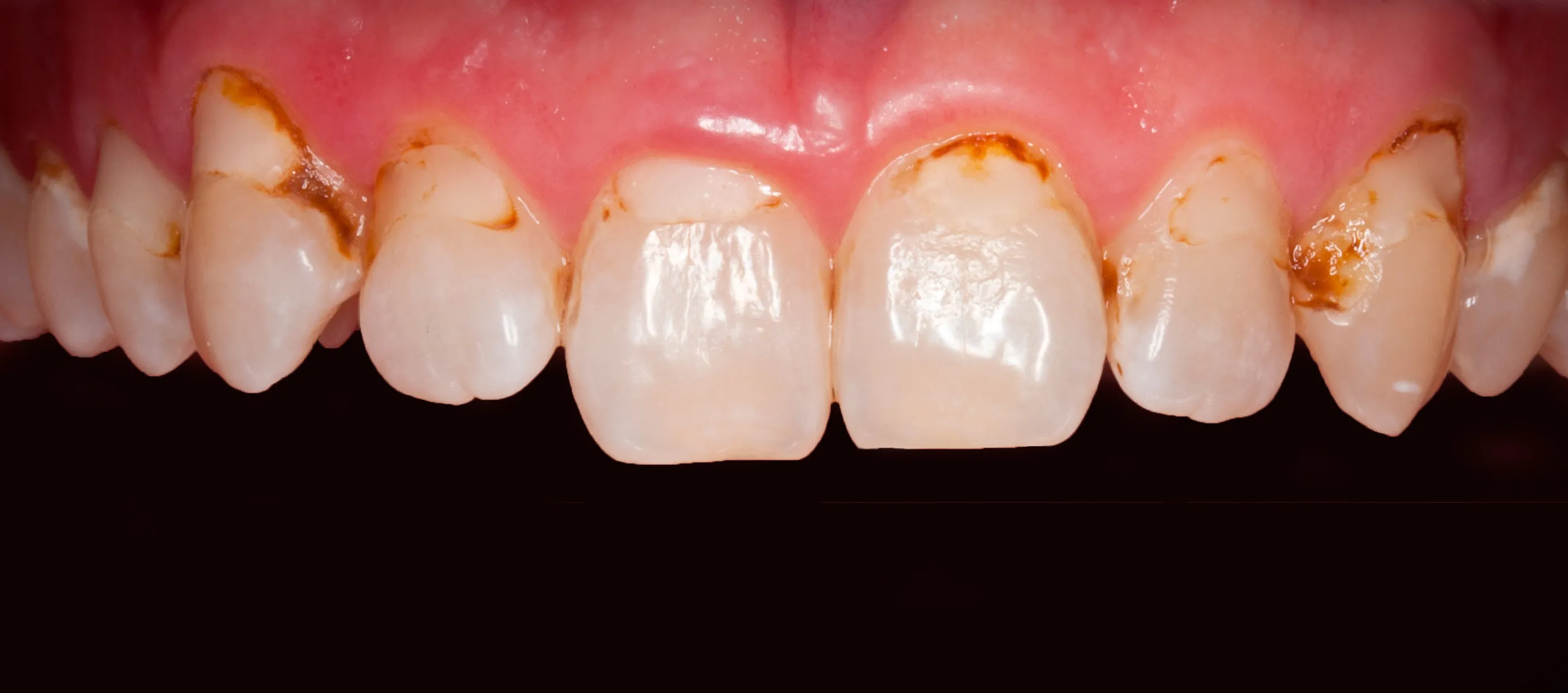 Vor der Behandlung — Rekonstruktion und Bleaching