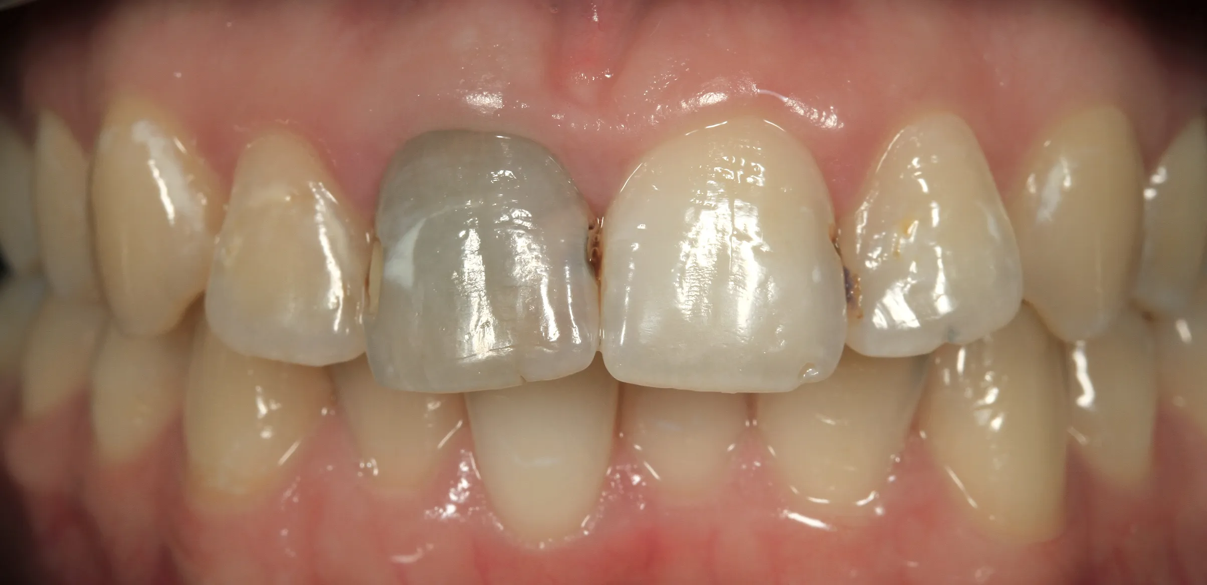 Vor der Behandlung — Internes Bleaching eines toten Zahns