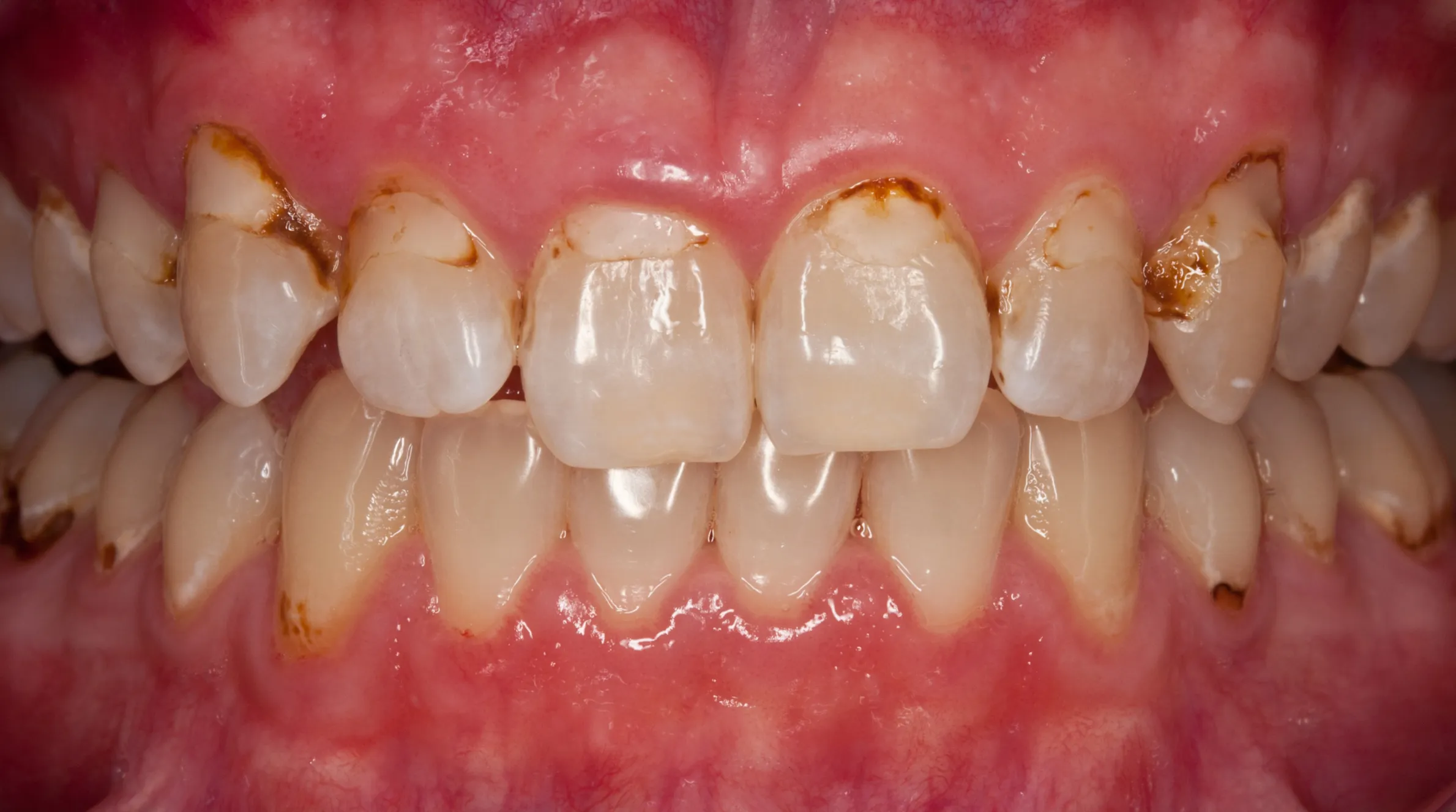 Vor der Behandlung — Rekonstruktion und Bleaching