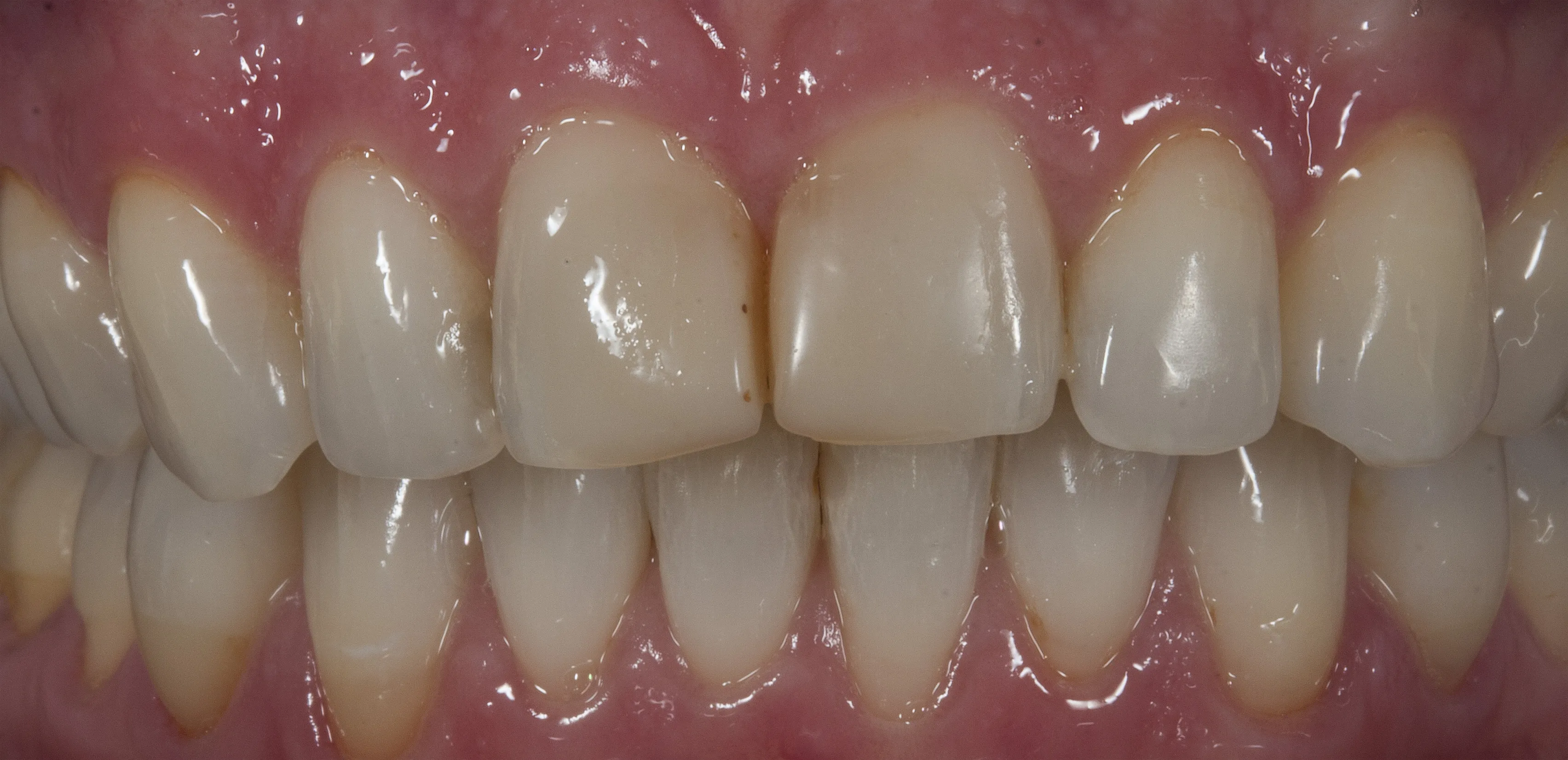 Vor der Behandlung — Bleaching und Behandlung der Frontzähne